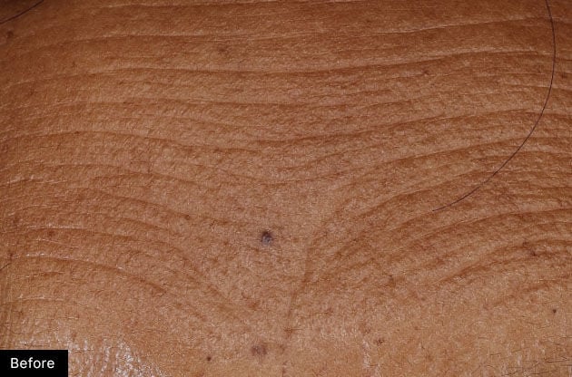 Forehead lines before H.A. Intensifier