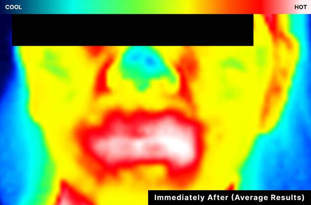 Infrared image showing cooler skin immediately after